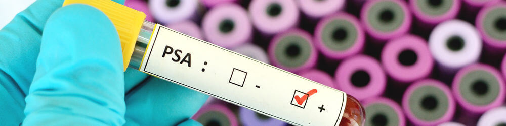screening-for-prostate-cancer