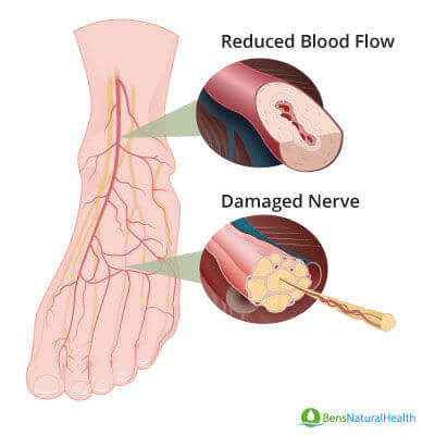 diabetic feet pictures
