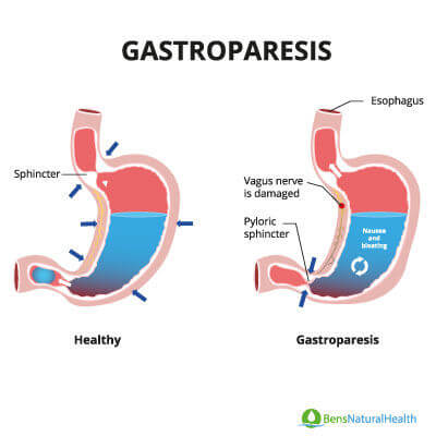 diabetic gastroparesis