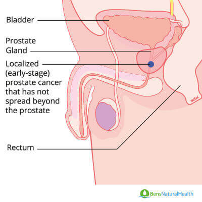 early signs of prostate cancer