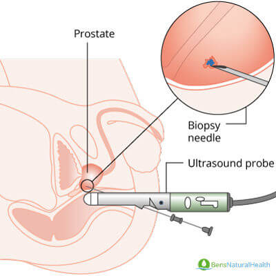 prostate biopsy procedure