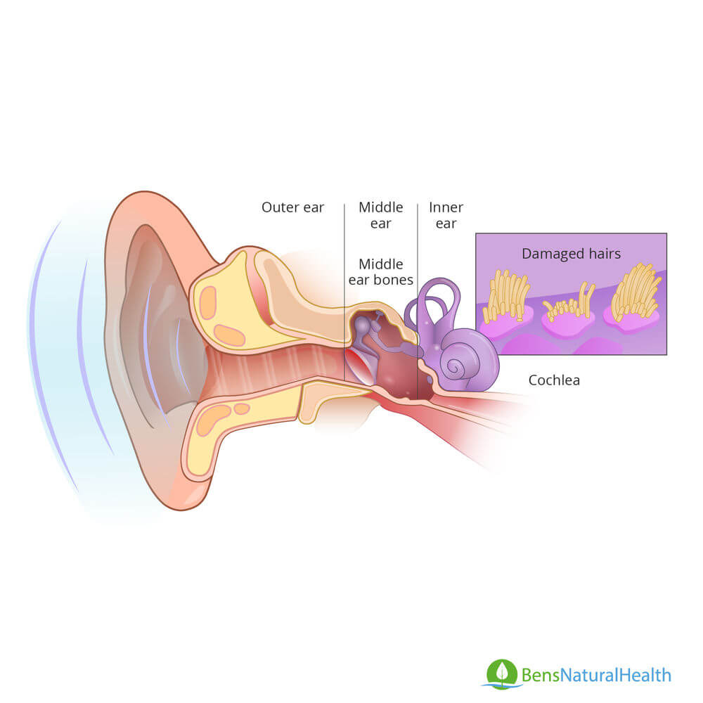 pulsatile tinnitus