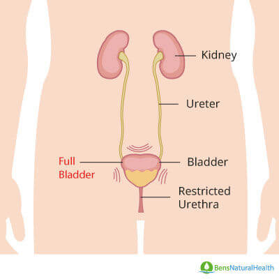 urinary retention in men