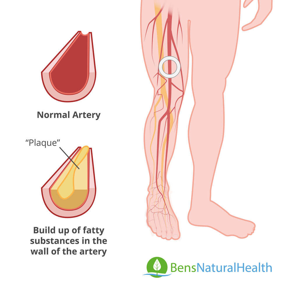peripheral artery disease
