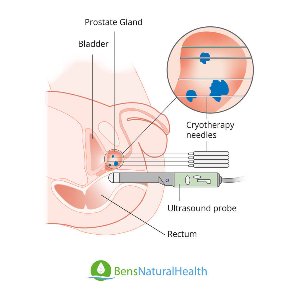 cryotherapy treatment