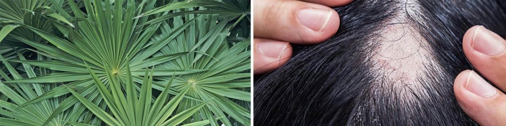 saw palmetto vs finasteride