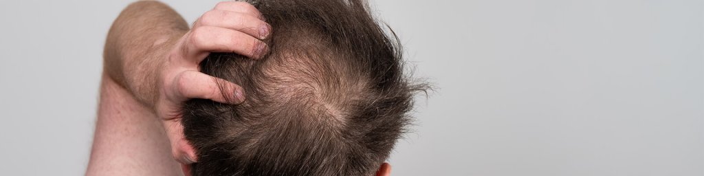 finasteride vs minoxidil