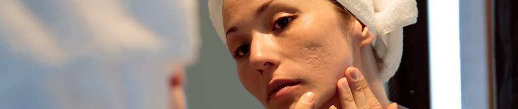 how to get rid of acne scars